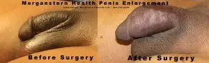 florida penis enlargements before after