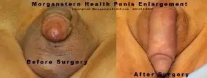 Before After Buried Penis Surgery