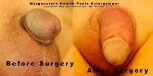 Closeup photos micro penises post surgery