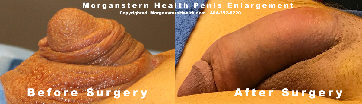 Penis Enlargement Pill Permanent Results.