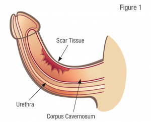 peyronies scar tissue penile correction image