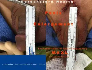 penis enlargement b4 after pic