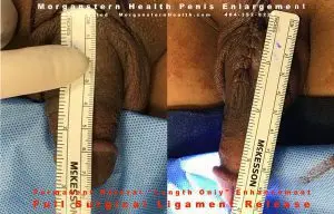 A ruler measuring a surgical site of a male undergoing penis lengthening.