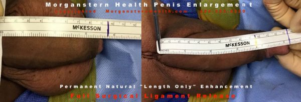 b4 after penis pics 1 inch extension