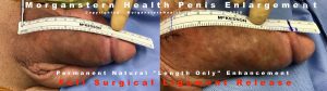 penis inches before and after surgery