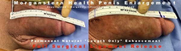 penis inches before and after surgery