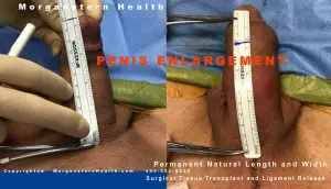 b4 after penis pics girth surgery