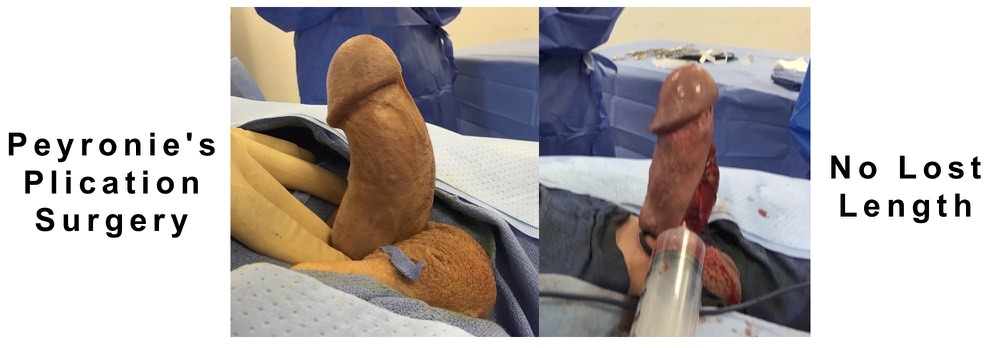 procedure to straighten curved penis